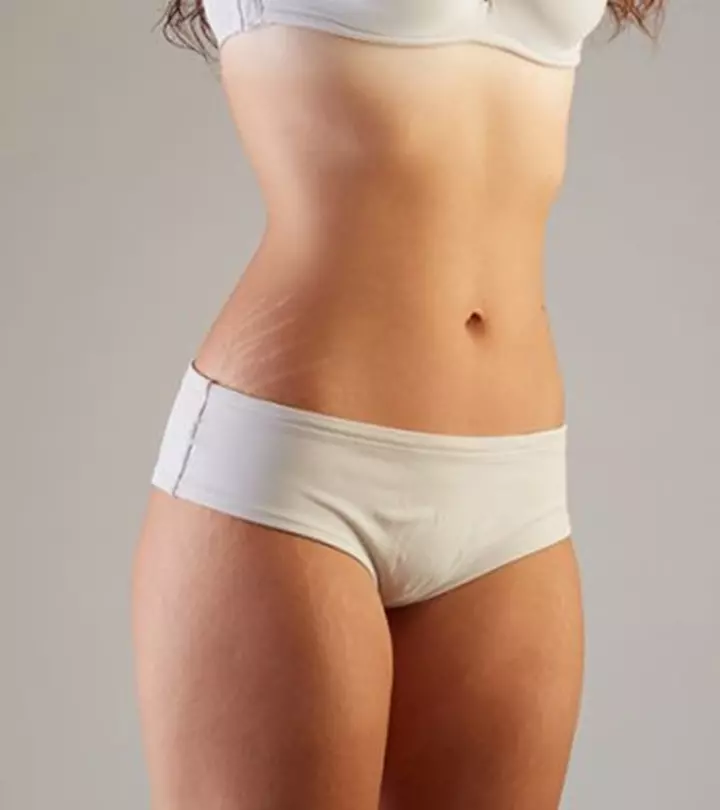 How To Treat Stretch Marks On Teens_image