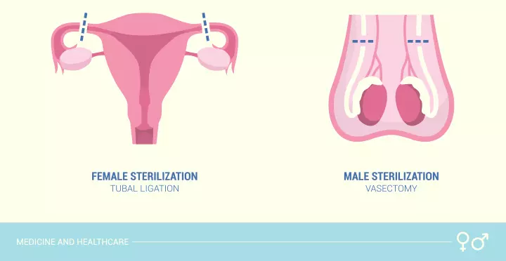 Surgical sterilization as non-hormonal birth control method