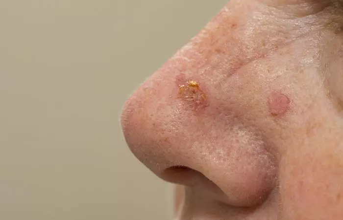 Actinic Keratosis