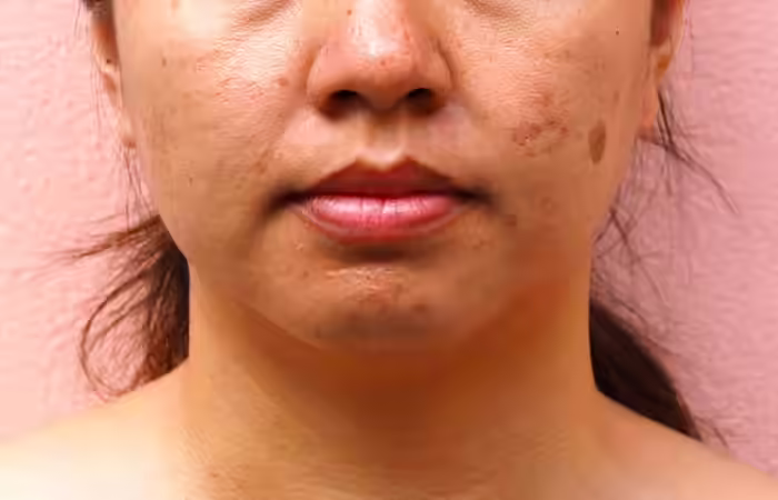 Melasma Melasma