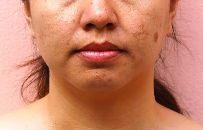 Melasma