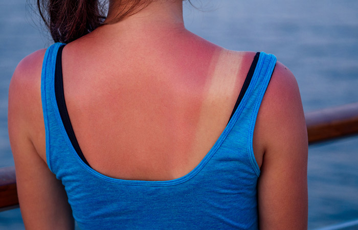Sunlight irritation