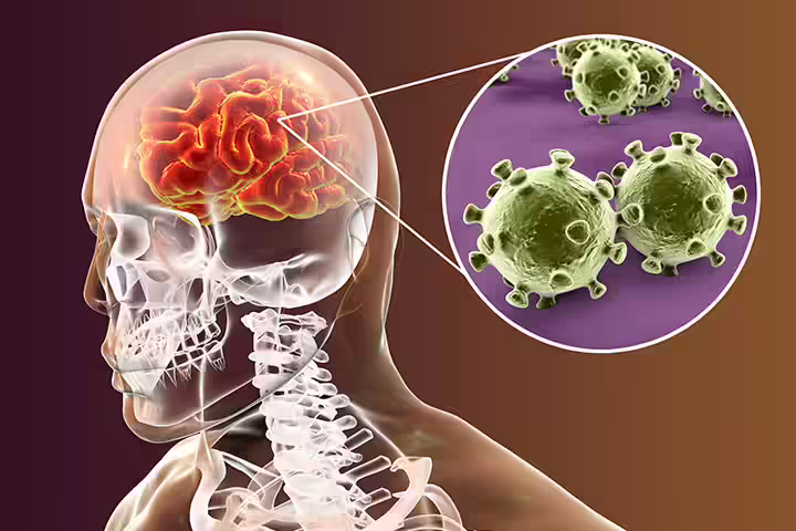 What Is Meningococcal Meningitis