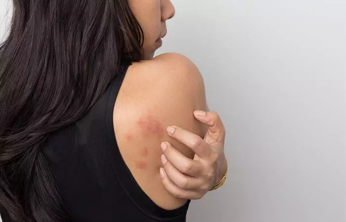 Keto Rash Signs And Symptoms