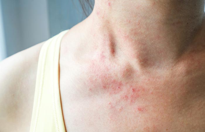 What Is Keto Rash What Causes It