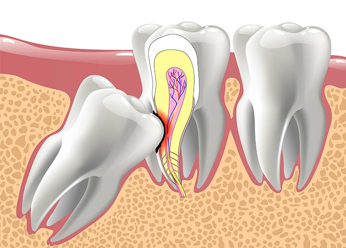 Wisdom Teeth
