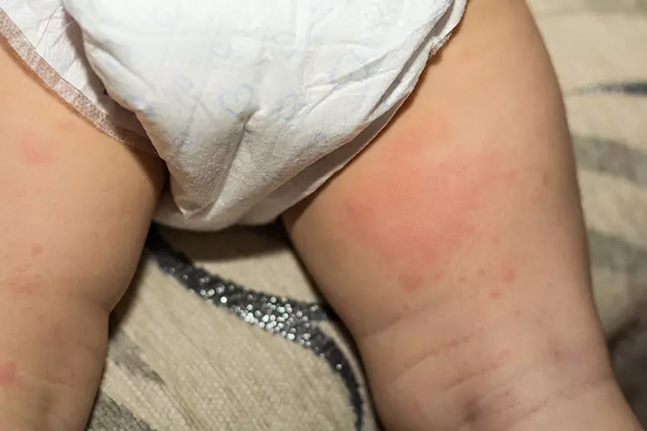 How To Identify Diaper Rash