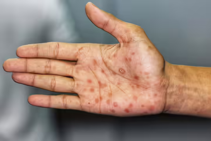The Stages Of Syphilis