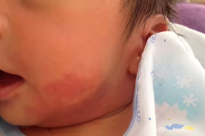 Types Of Birth Marks