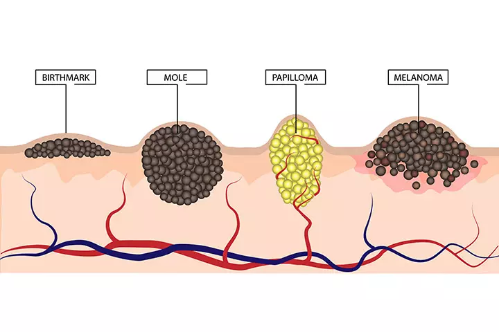 What Scientists Say About Birthmarks