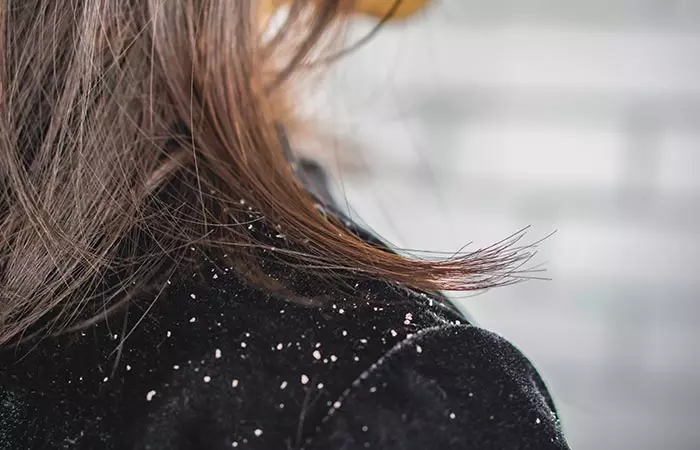 Dandruff