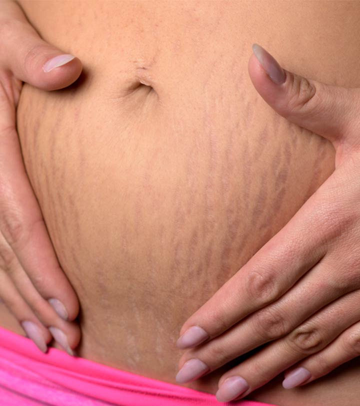 I Followed This Simple Routine To Get Rid Of Stretch Marks. And It Works_image