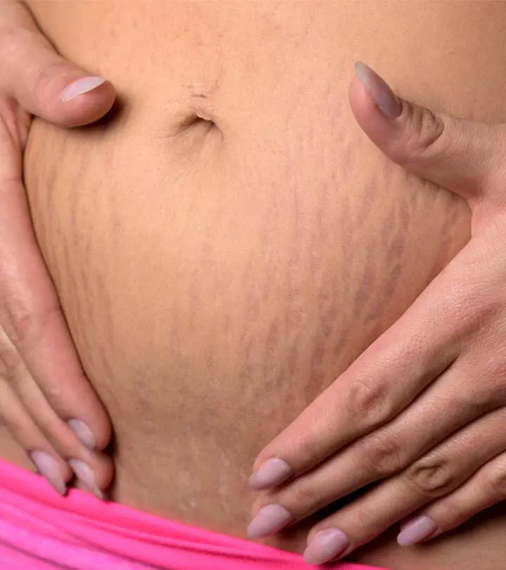 I Followed This Simple Routine To Get Rid Of Stretch Marks. And It Works