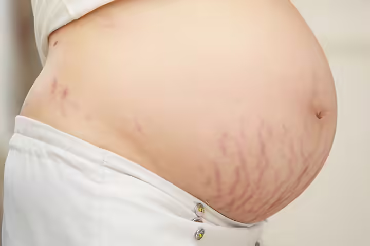 Stretch Marks