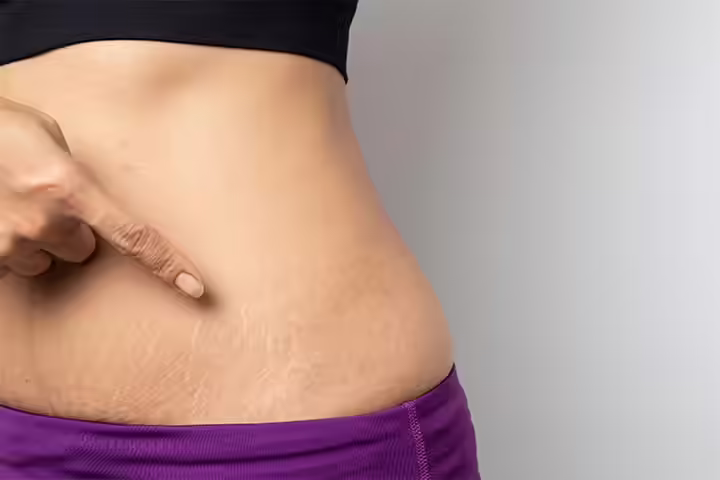 What Are Stretch Marks And Where Do They Come From