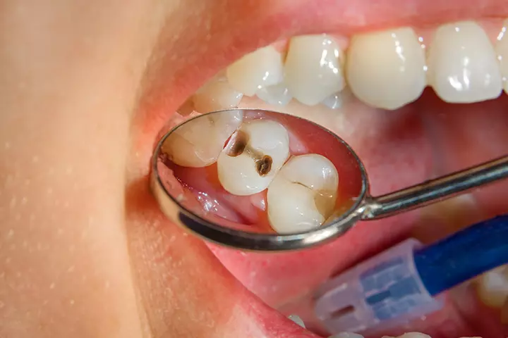 Dental Caries