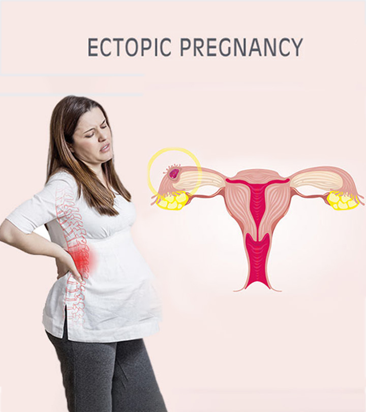 Ectopic Pregnancy Meaning In Tamil