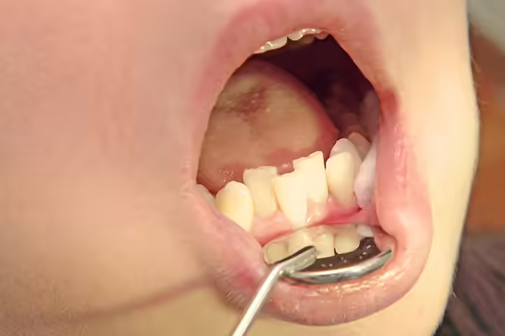 Over-Crowded Teeth