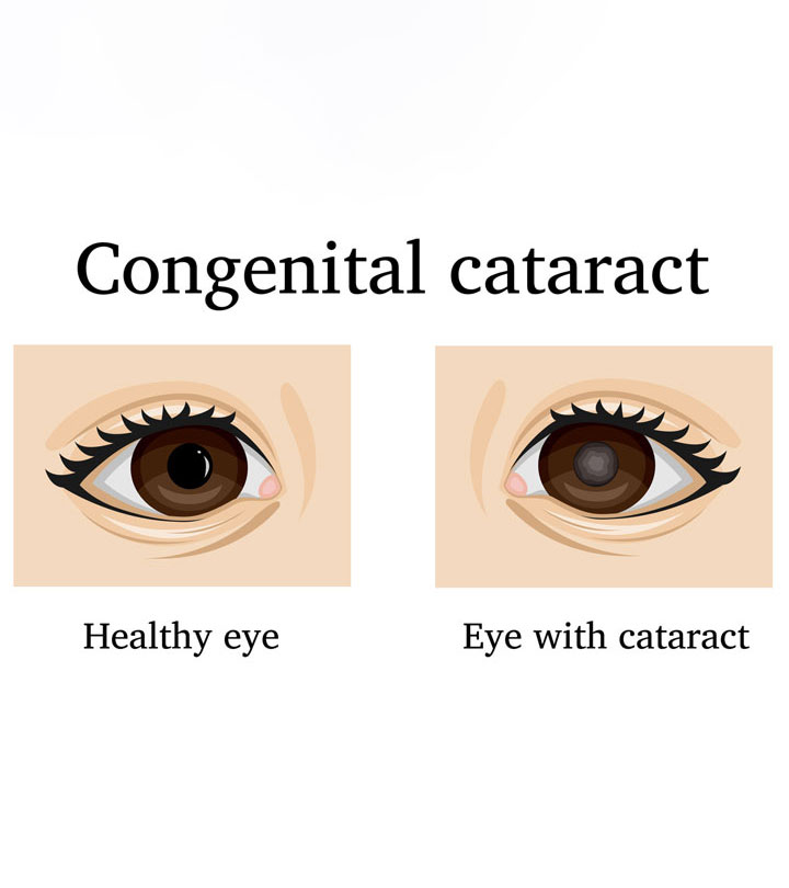 शिशु में मोतियाबिंद के लक्षण, कारण व  इलाज | Cataract In Babies Eye In Hindi