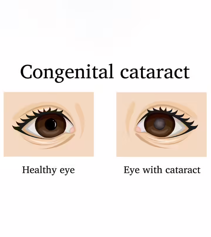 Cataract In Babies Eye In Hindi