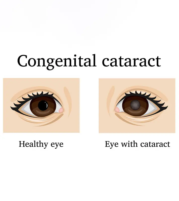 शिशु में मोतियाबिंद के लक्षण, कारण व  इलाज | Cataract In Babies Eye In Hindi_image