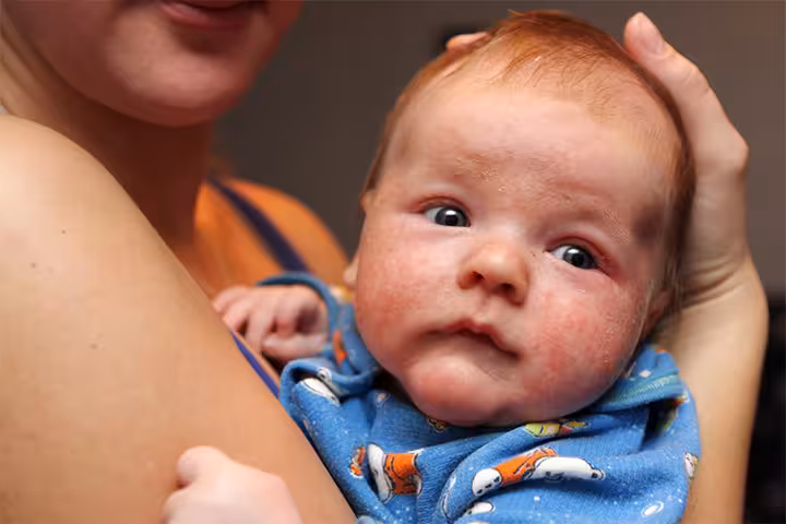 Eczema In Infants Causes, Symptoms