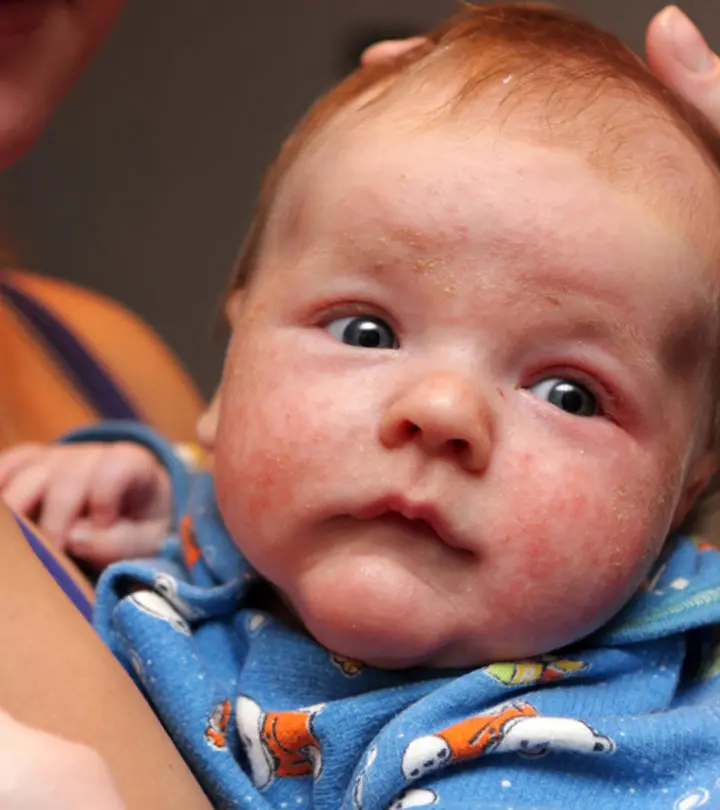 Eczema In Infants Causes, Symptoms