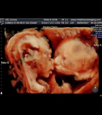 Pregnant Moms Ultrasound Reveals Twin Babies Kissing Inside The Womb