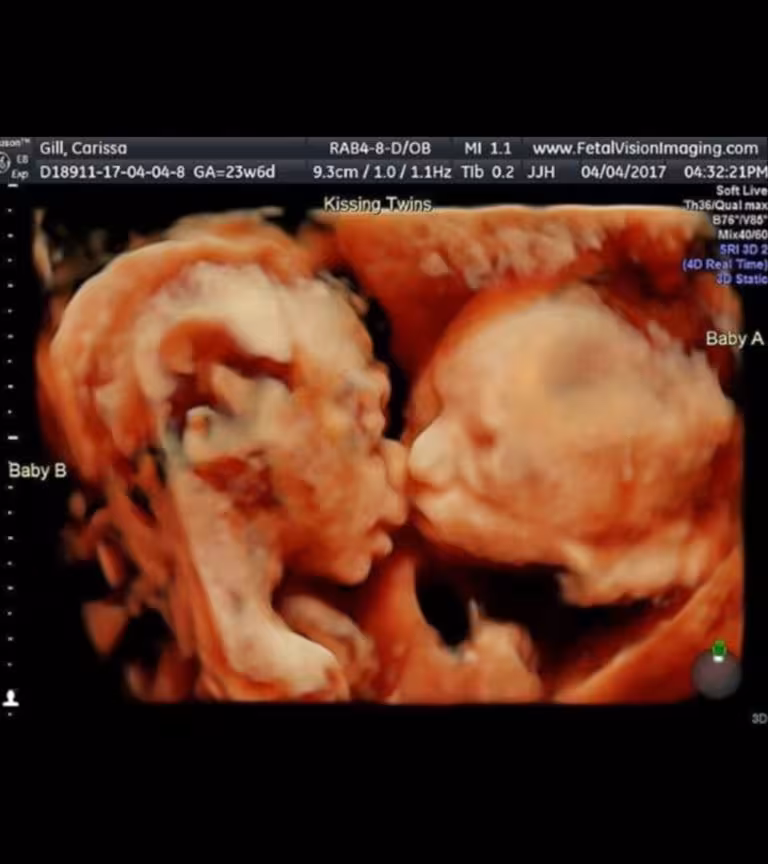Pregnant Moms Ultrasound Reveals Twin Babies Kissing Inside The Womb
