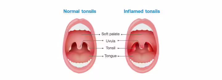 How Does Tonsillitis Look In Children.jpg How Does Tonsillitis Look In Children.jpg