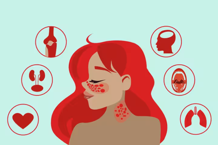 Lupus In Children Symptoms Causes