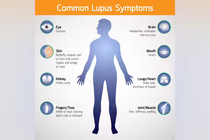 Common symptoms of lupus in children Common symptoms of lupus in children