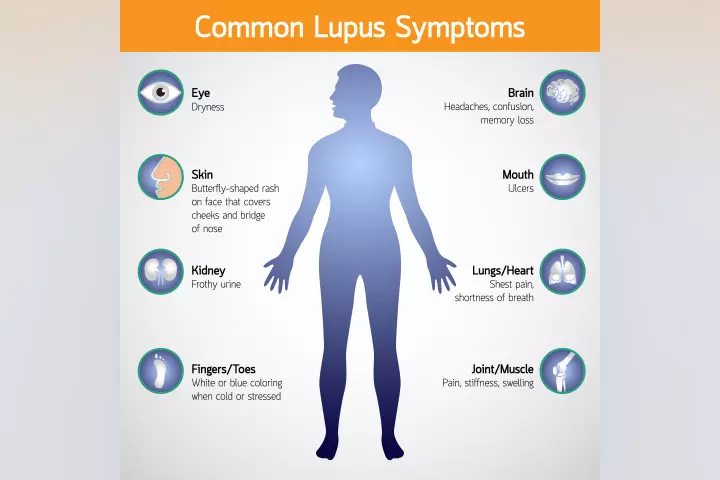 16 Symptoms Of Lupus In Children, Types, Causes & Treatment