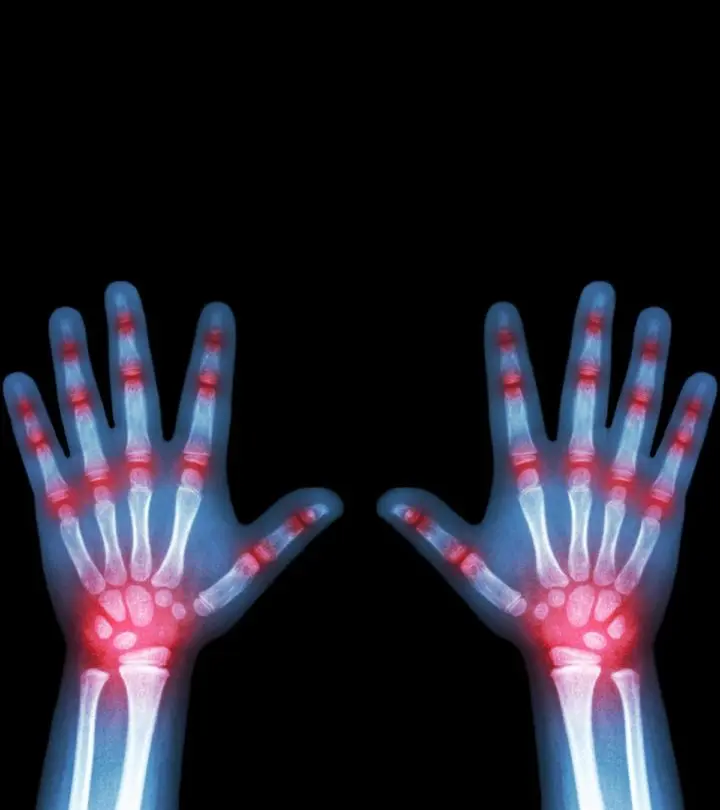 9 Symptoms Of Arthritis In Children, Causes And Treatment