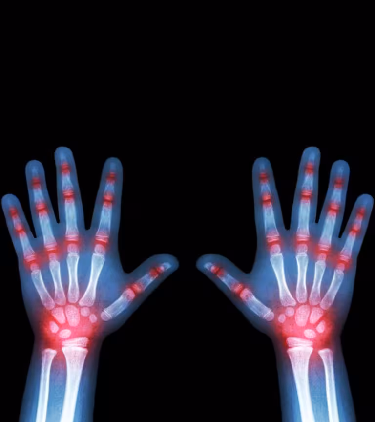 9 Symptoms Of Arthritis In Children, Causes And Treatment
