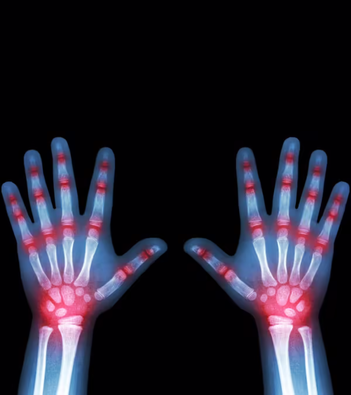 9 Symptoms Of Arthritis In Children, Causes And Treatment