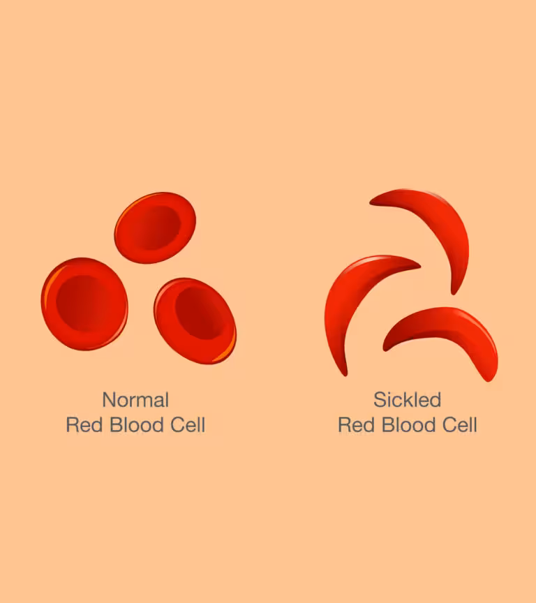 ALS (Amyotrophic Lateral Sclerosis) In Children Causes And Symptoms