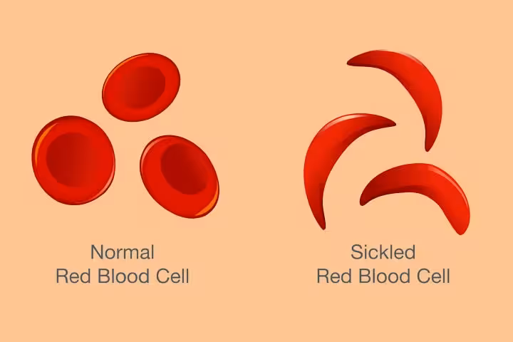 ALS (Amyotrophic Lateral Sclerosis) In Children Causes And Symptoms1
