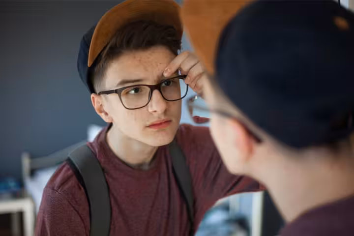 Acne In Children Causes, Treatment, Remedies And When To Worry-1