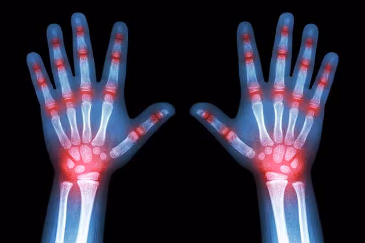 Arthritis In Children