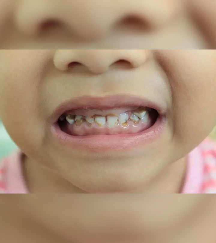 Baby Bottle Tooth Decay: Causes, Symptoms And Prevention