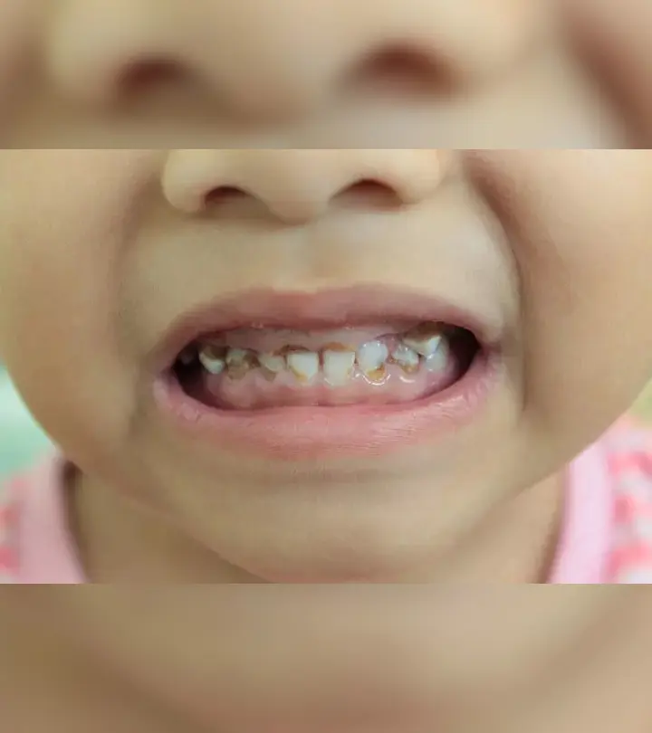 Baby Bottle Tooth Decay: Causes, Symptoms And Prevention