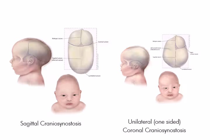 Craniosynostosis In Babies Causes Symptoms Treatment