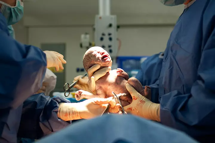 Cesarean-Born Infants At Elevated Danger Of Infection-Related Hospitalization In Childhood