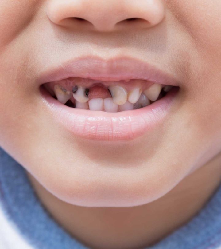 Child Tooth Decay Pictures, Causes And Treatment Options