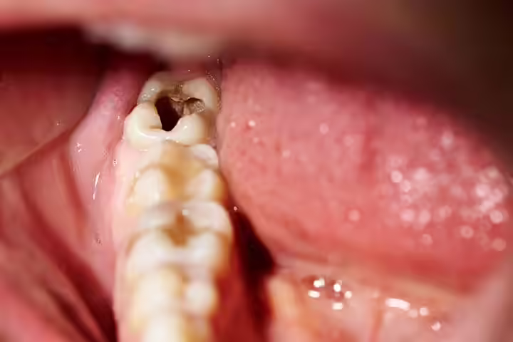 Signs And Symptoms Of Tooth Decay In Children Signs And Symptoms Of Tooth Decay In Children