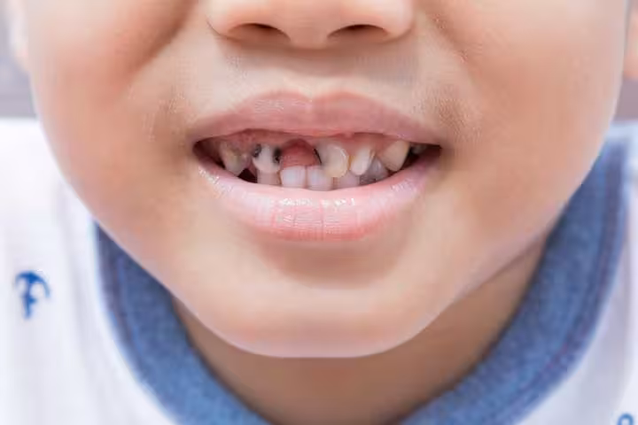 Tooth Decay (Rotten Teeth) In Children