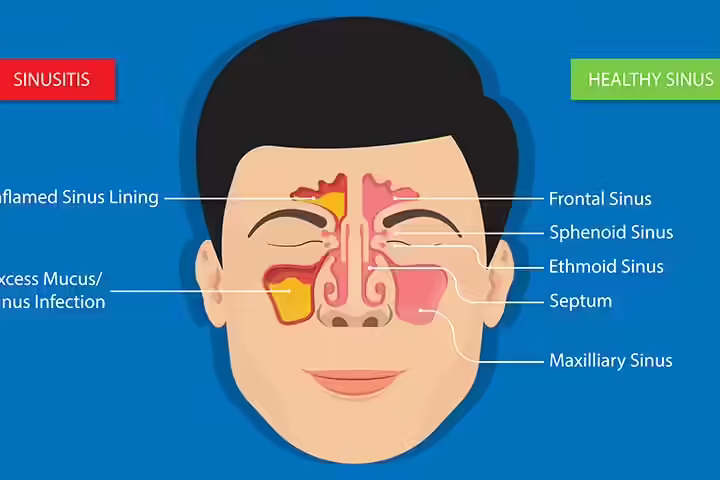 Healthy sinus vis-a-vis sinusitis Healthy sinus vis-a-vis sinusitis