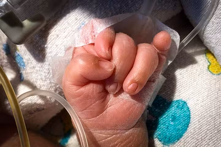Edwards Syndrome Trisomy 18 In Babies Causes And Treatment-1
