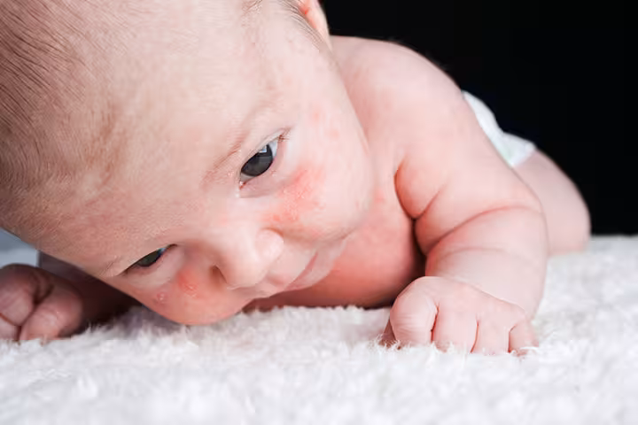 Milia In Newborn Babies Causes, Types, Symptoms, And Treatment